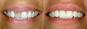 Smile Gallery - Smile Town Dental, Addison Dentist