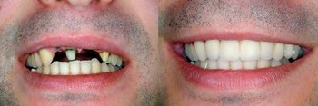 Smile Gallery - Smile Town Dental, Addison Dentist