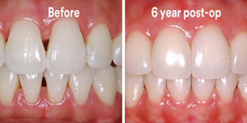 BioClear Diastema Closure and Black Triangle Closure  - Smile Town Dental, Addison Dentist