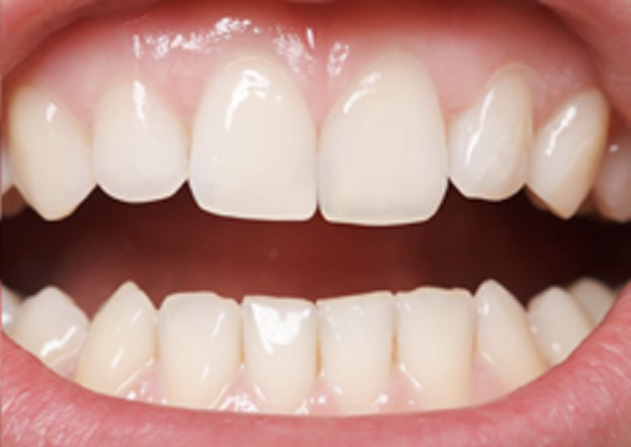 Cosmetic Bonding  - Smile Town Dental, Addison Dentist