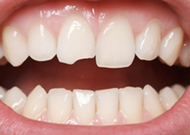 Cosmetic Bonding  - Smile Town Dental, Addison Dentist