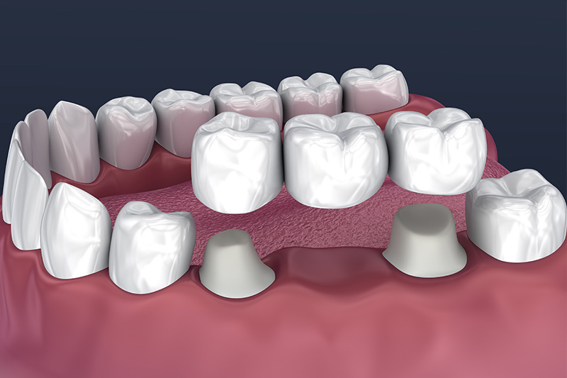 Crowns and Bridges, Inlays and Onlays  - Smile Town Dental, Addison Dentist