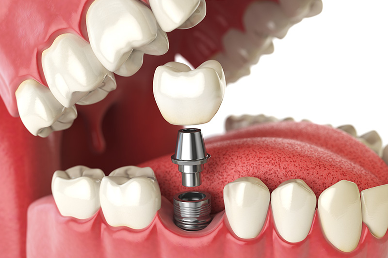 Dental Implants - Smile Town Dental, Addison Dentist