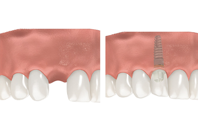 Dental Implants - Smile Town Dental, Addison Dentist