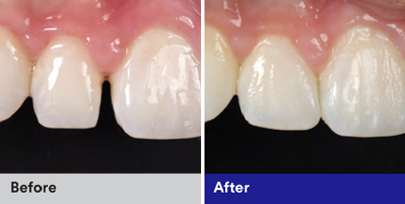 BioClear Diastema Closure and Black Triangle Closure  - Smile Town Dental, Addison Dentist