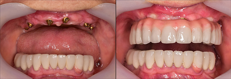 Implant Overdentures and Fixed All-On-X Treatment  - Smile Town Dental, Addison Dentist