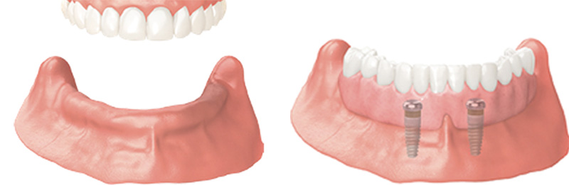 Implant Overdentures and Fixed All-On-X Treatment  - Smile Town Dental, Addison Dentist