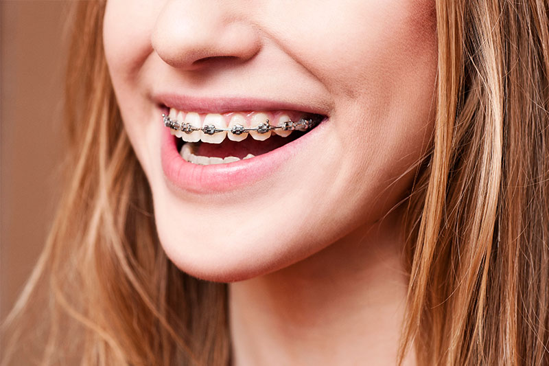 Orthodontics - Smile Town Dental, Addison Dentist