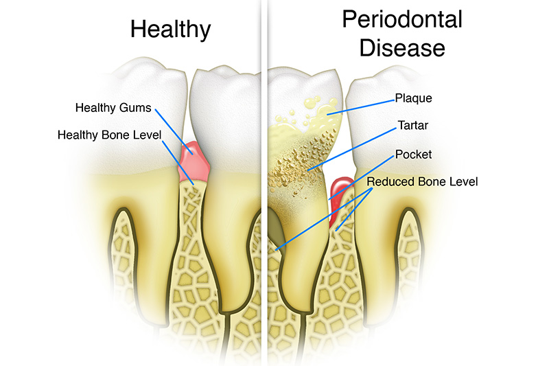 Scaling & Root Planings (Deep Cleanings)  - Smile Town Dental, Addison Dentist