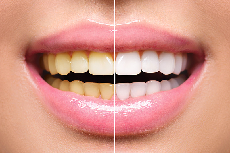 Teeth Whitening - Smile Town Dental, Addison Dentist