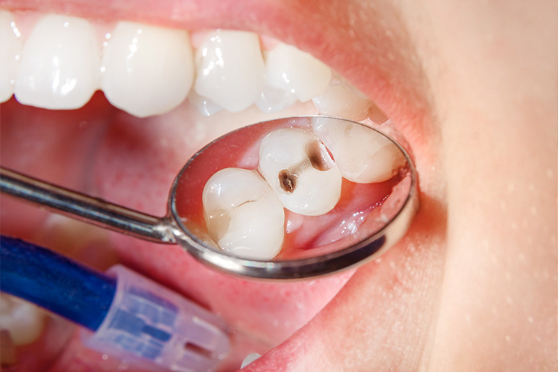 Tooth Colored Composite Fillings  - Smile Town Dental, Addison Dentist