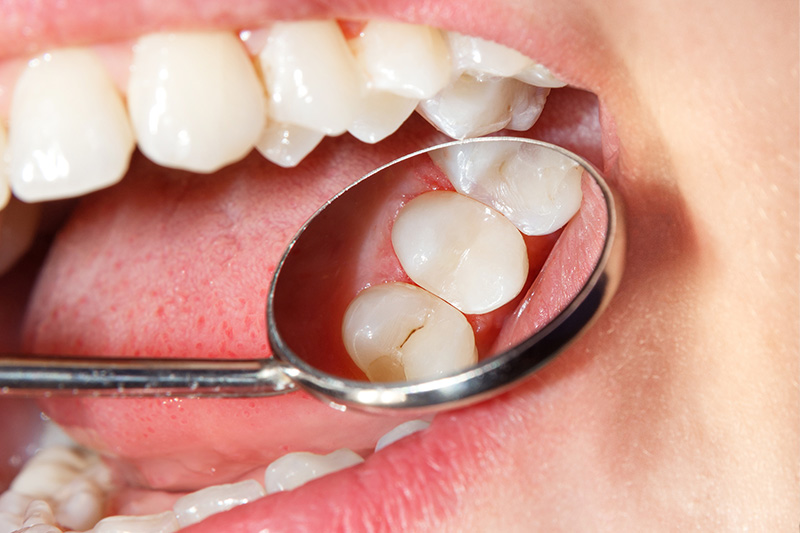 Tooth Colored Composite Fillings  - Smile Town Dental, Addison Dentist