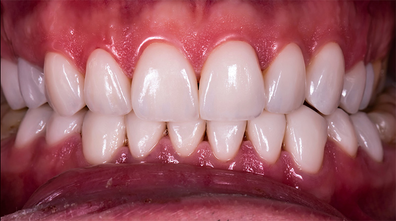 Veneers  - Smile Town Dental, Addison Dentist